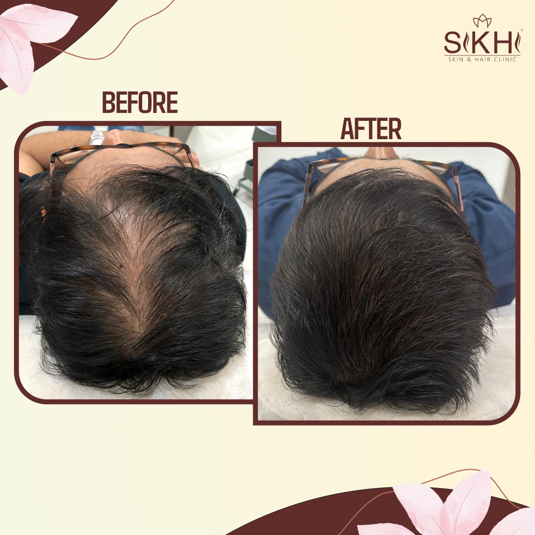 SIKHI BEFORE AFTER-1