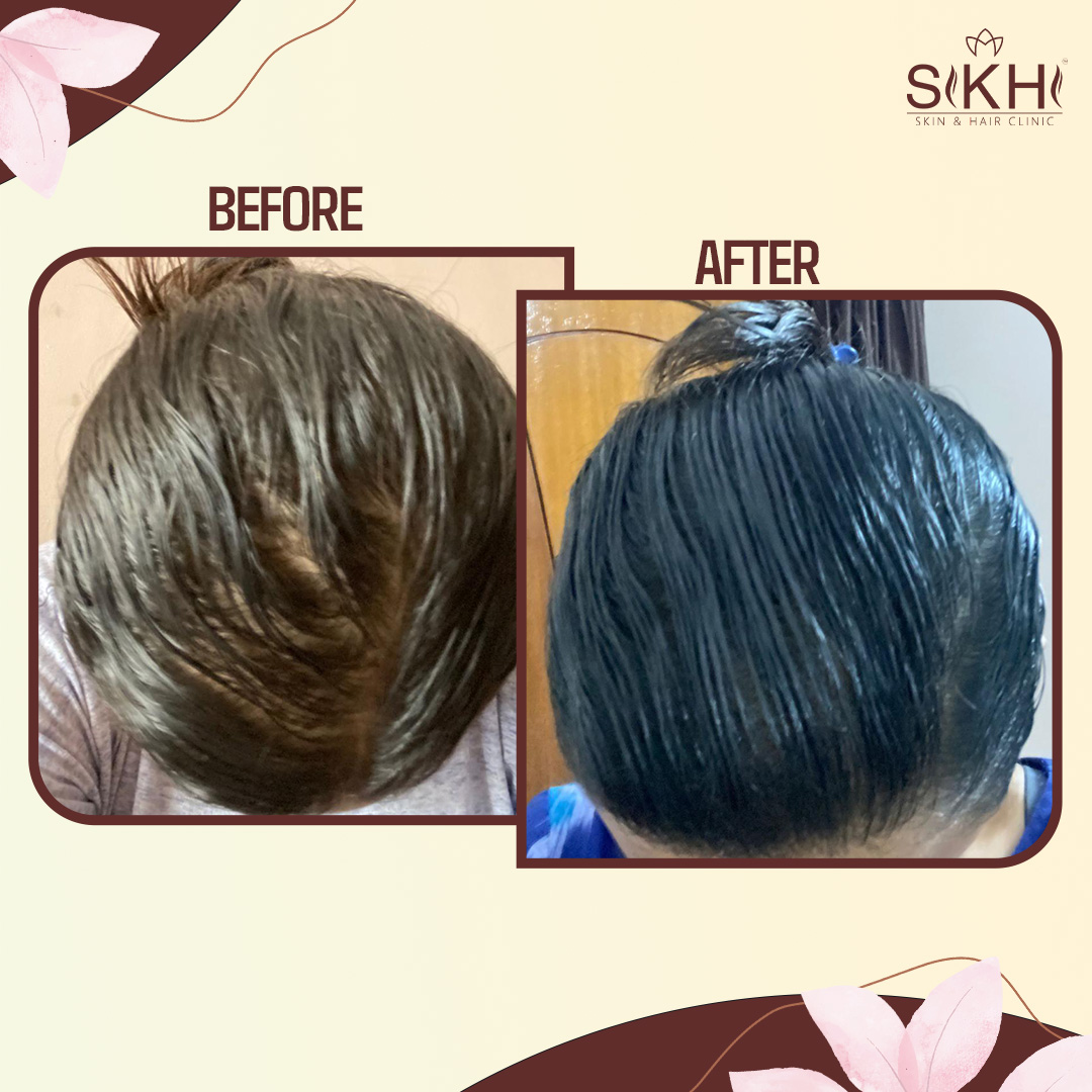 SIKHI BEFORE AFTER-2