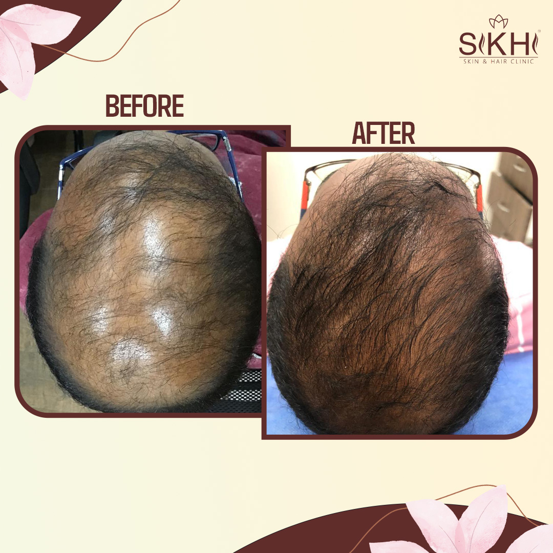 SIKHI BEFORE AFTER-3
