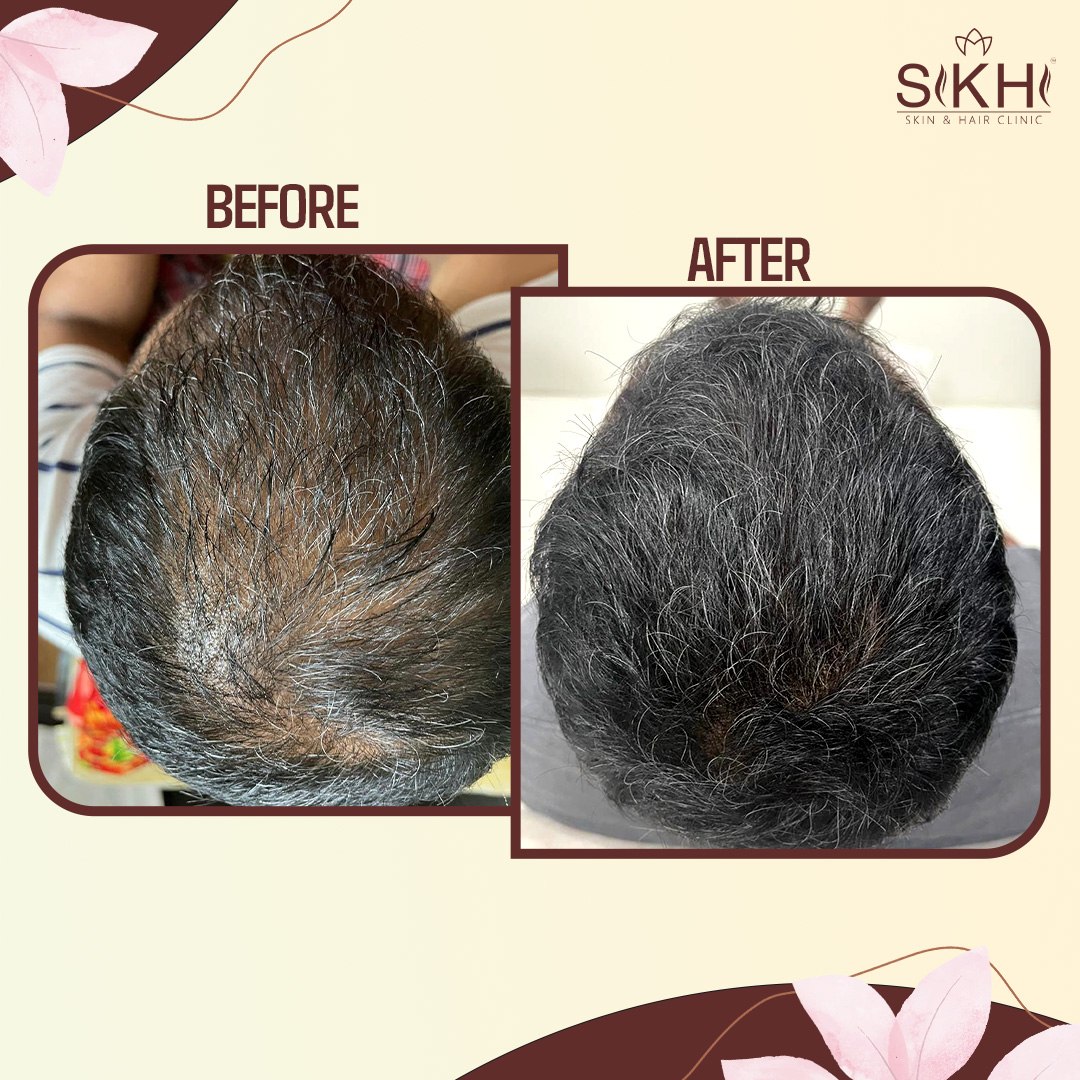 SIKHI BEFORE AFTER-4